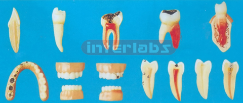 TEETH DISEASE SERIES MODEL